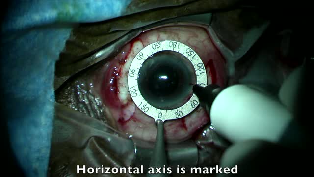 The Evolution of IOL Fixation Part III: Small Incision
