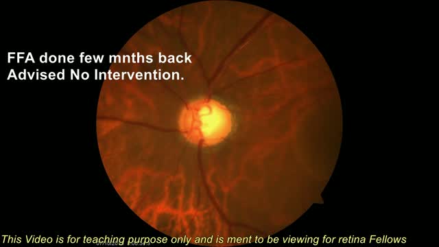 Fovea Sparing ILM Peel for Maculopathy Associated with Atypical Pit