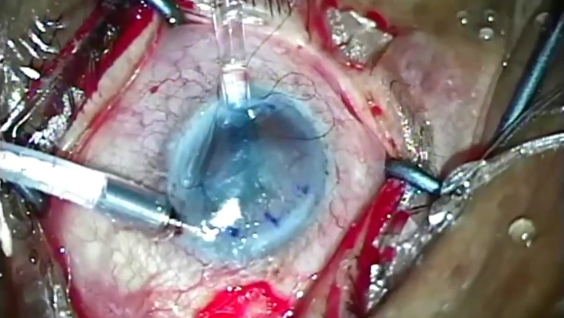 One Cornea for Two Patients