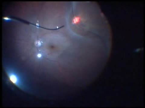 27-Gauge Vitrectomy