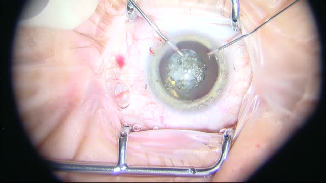 Dysfunctional Lens Replacement Using an Active Fluidics and Balanced Phaco Tip