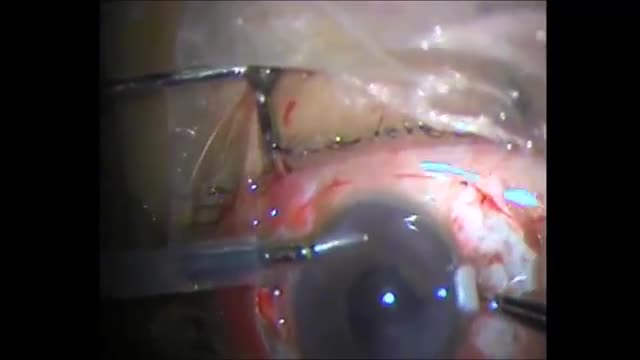 Conquering the Catastrophy in Glued IOL Surgery