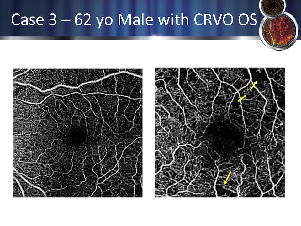 Case Reports: OCT-A to Visualize ischemia and capillary drop-out in Retinal Vein Occlusion