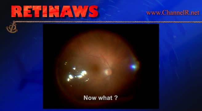 Retinal Detachment & Macular Hole