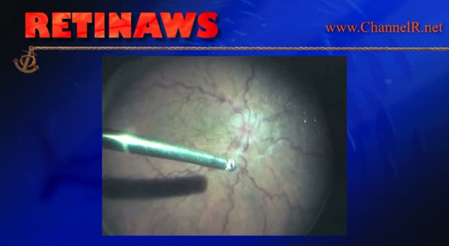 Hypotony Post Cataract Surgery