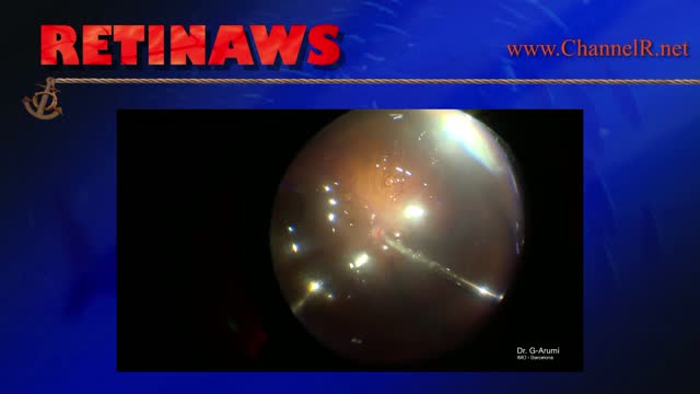 Choroidal Melanoma