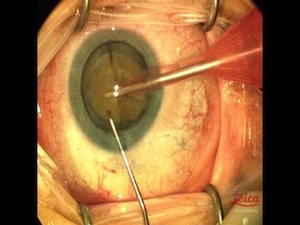 Vertical Chopping the Hypermature White Cataract