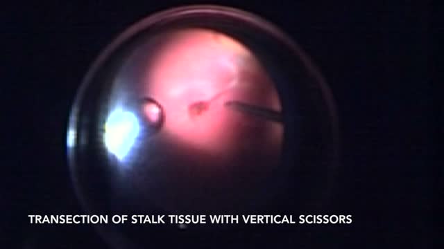 Two-port Vitrectomy for Persistent Fetal Vascular Syndrome