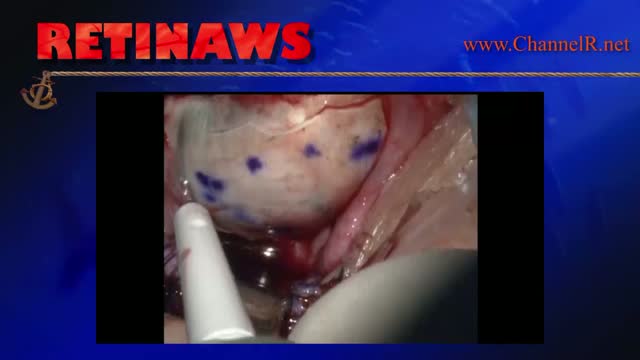 Melanoma