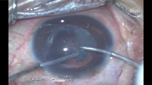 Management of Pediatric Cataract in Eyes Treated for Retinoblastoma