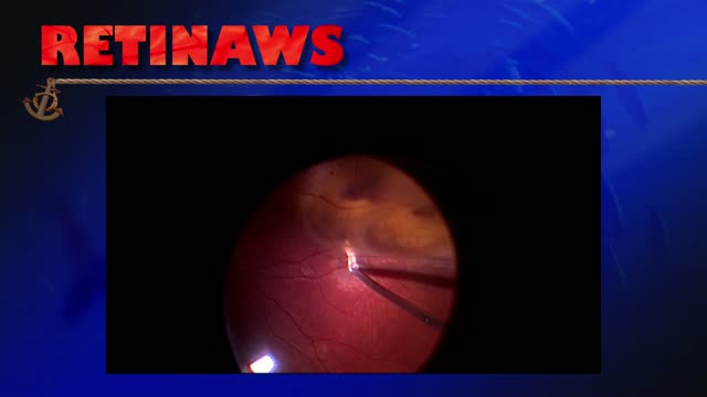 Vascularized Retina Hamartoma