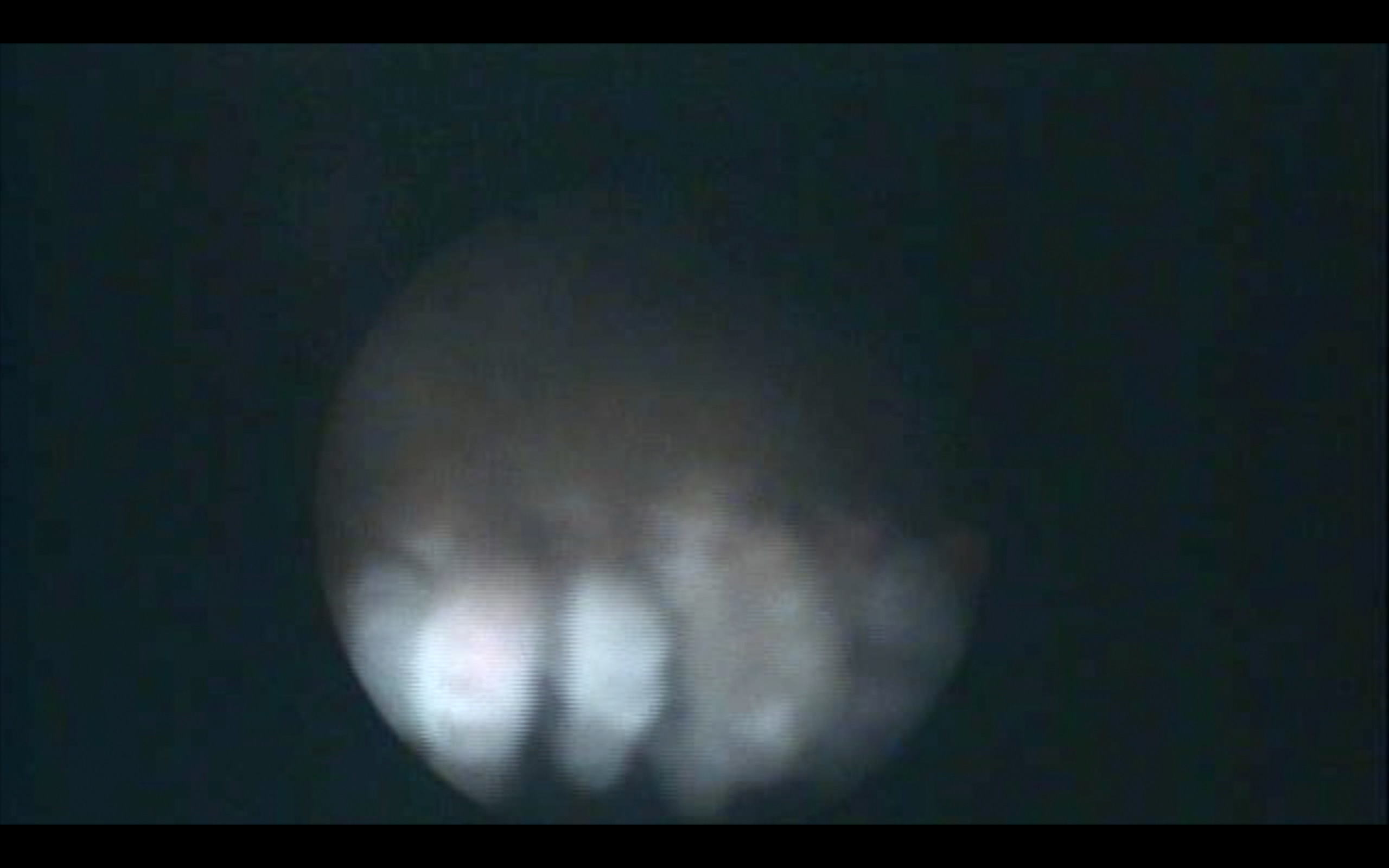 Laser Cataract Surgery Combined With ECP