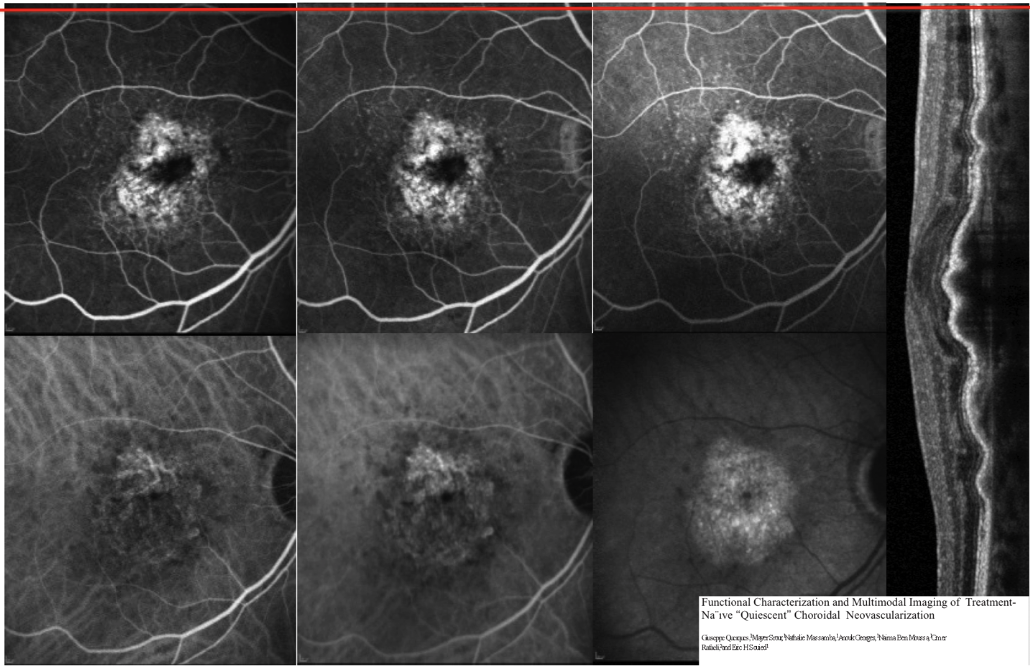 Using OCT-A to Visualize Quiescent Neovascularization