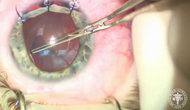 Complex Phaco and Iridodialysis