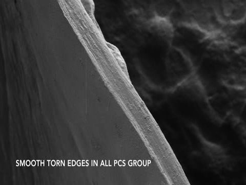 Laser Versus Manual Cataract Surgery