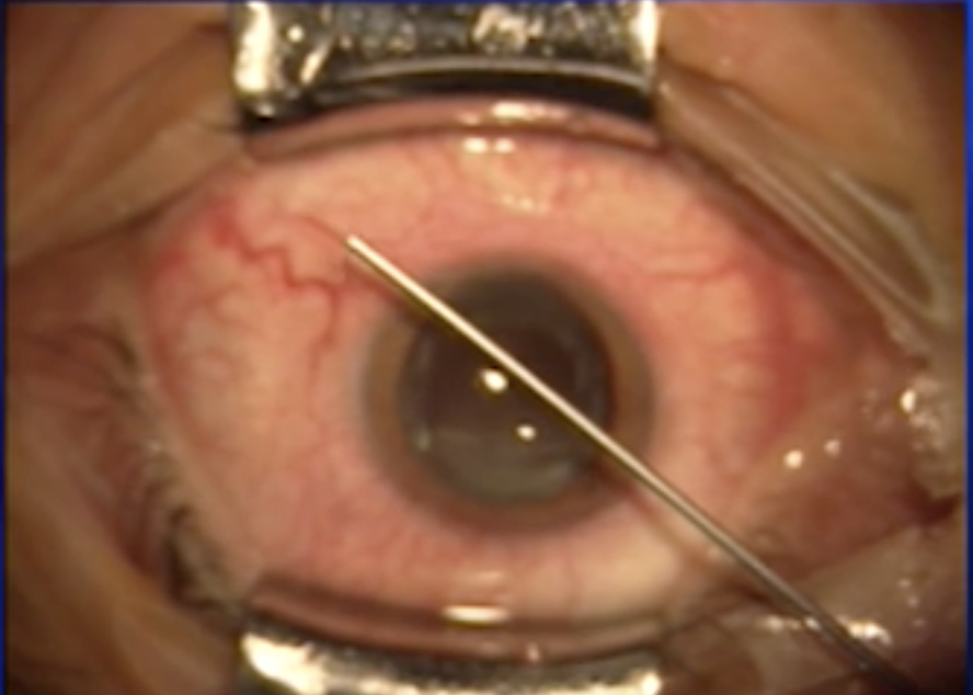 Subretinal Hemorrhage