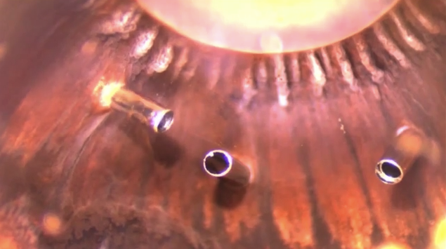 Cannula Effect on Internal Ocular Tissues