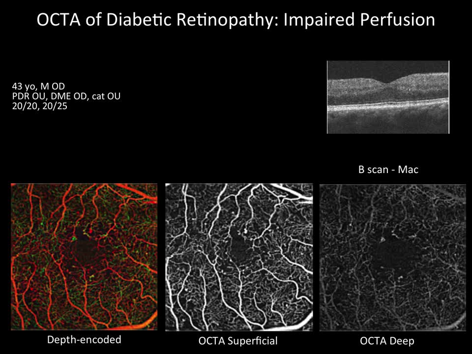 Case Reports : Using OCT-A assessment to stage DR