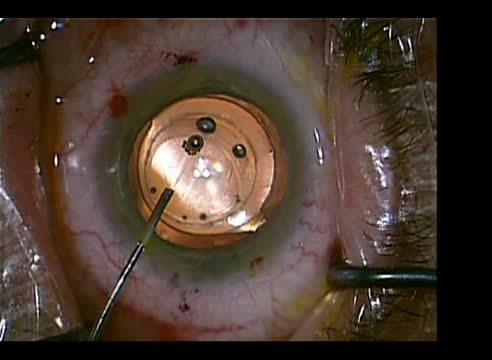 Femtosecond Laser in IOL Exchange
