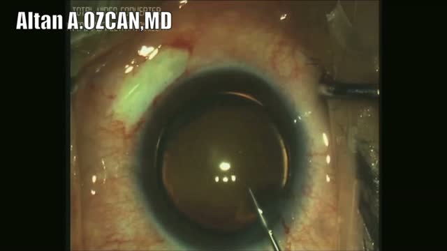 Management of Severe Subluxated Crystalline Lens by Phacoemulsification with Cionni Modified CTR