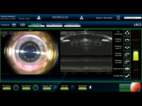 Femtosecond Laser Cataract Surgery Using the Storz Zero Phaco IA Hand Piece