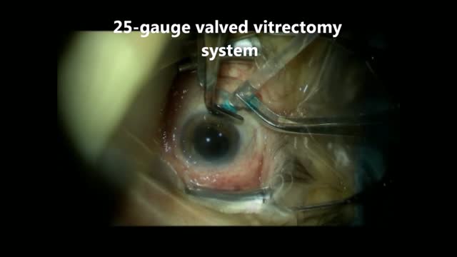 Removal of Persistent Silicone Oil Droplet from the Anterior Chamber