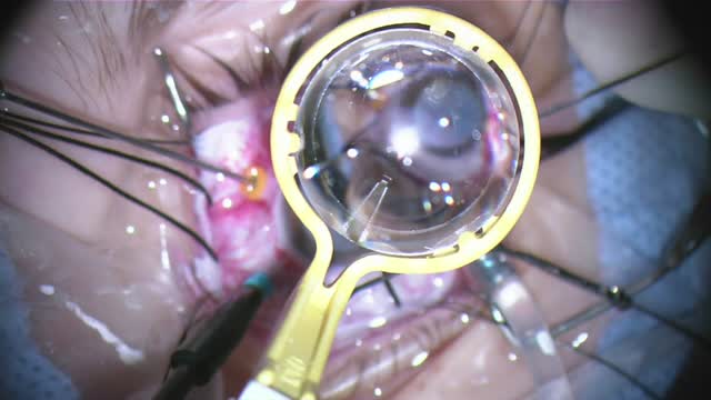 En Bloc Resection of Retinal Hemangioma With Combined Tractional and Serous Retinal Detachment