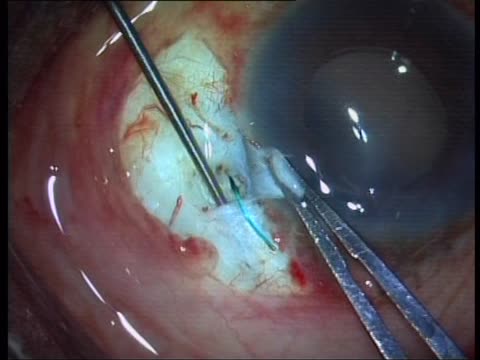 Glued IOL Live Surgery