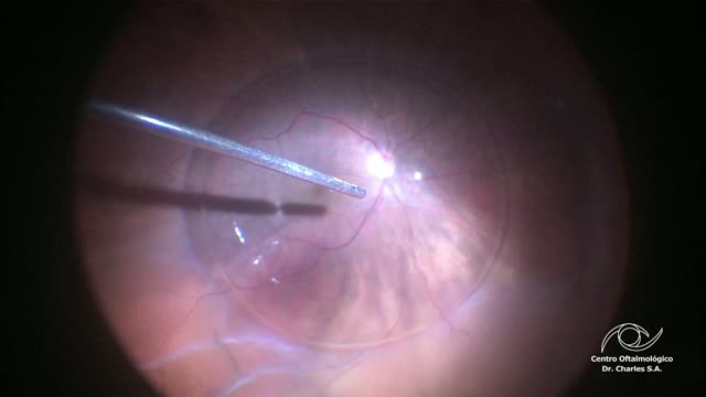 Preventing Retinal Jet Fluid Damage
