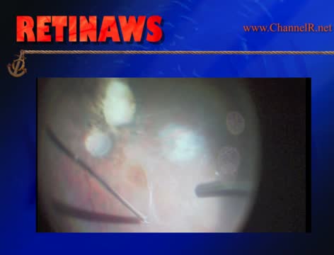 Membrane Peeling