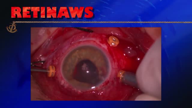 Choroidal Hemorrhage