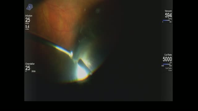 Scleral-Depressed Vitrectomy