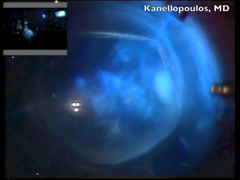 Challenging Cataract 2014