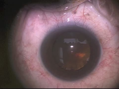 Phaco-Vitrectomy With Silicone Oil Removal and Membrane Peel