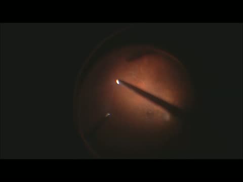 Retinoschesis
