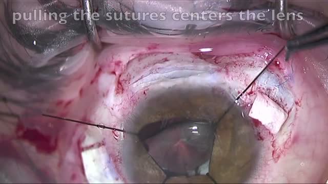 Scleral Sutured IOL