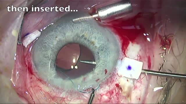 Modified Haptic Tuck Technique for Scleral-Fixated IOL