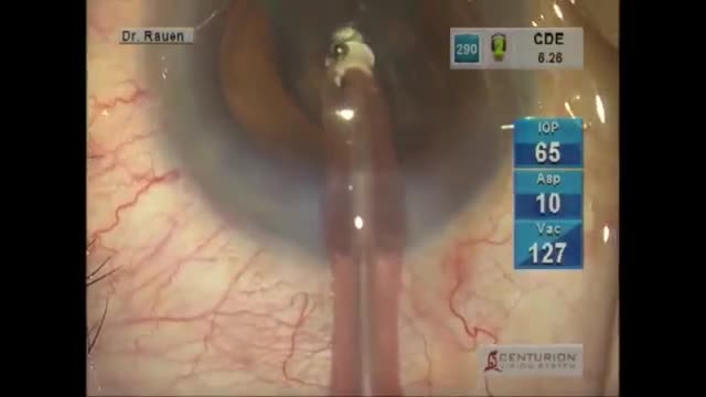 Fluidics of the Alcon Centurion Cataract Surgery System