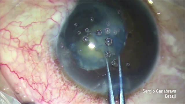 A New Approach to Treat Iris Coloboma