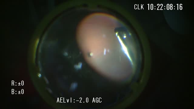 Peripheral Vitrectomy Under Air Infusion