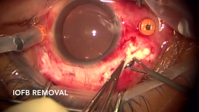 Intraocular Foreign Body Removal with 23G Vitrectomy 