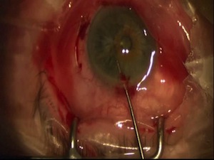 Repairing Flomax-Related Injured Iris After Cataract Surgery
