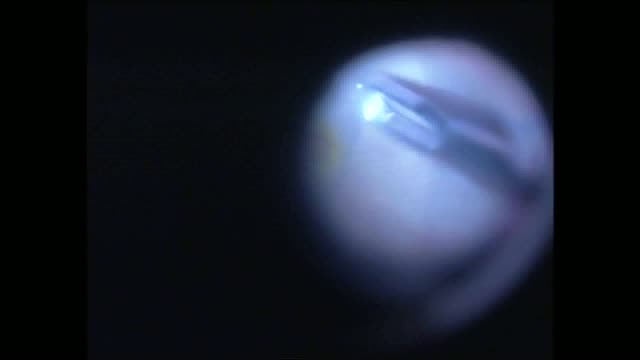 Modified Inverted Flap Technique for Macular Hole Surgery