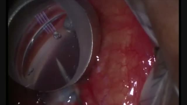 Ab-interno Suprachoroidal Catheterization for Treatment of Open Angle Glaucoma
