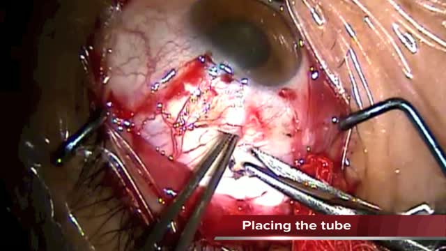 Non Extrusion B Drainage Device Technique