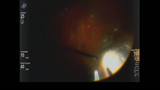 Scleral-Depressed Peripheral Laser