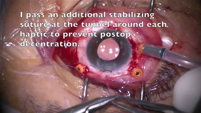 Sutureless Scleral Fixation: Tips to Make it Work for You