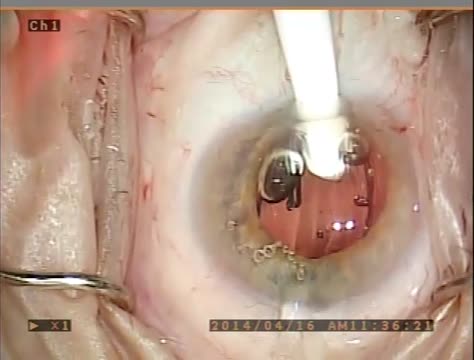 Dropless Cataract Surgery