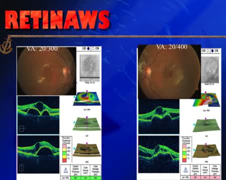 Intravitreal Injection