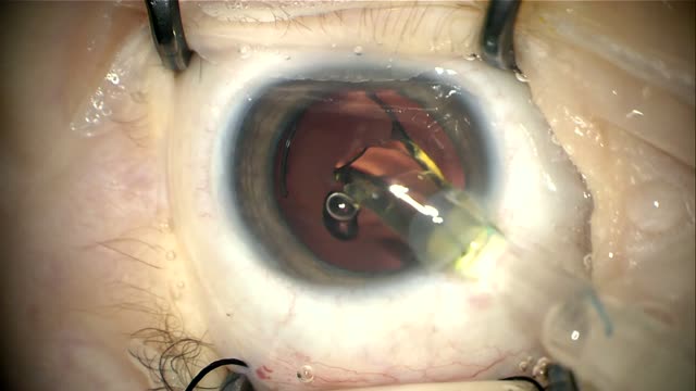 Bilateral Congenital Cataract Surgery on a 45-Day-Old Baby: Left Eye